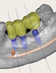 3D Implantatplanung 3D Implantatplanung