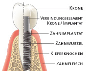 Implantate